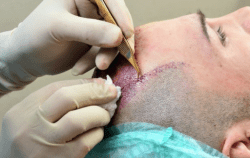 کاشت موی طبیعی- زیبایان